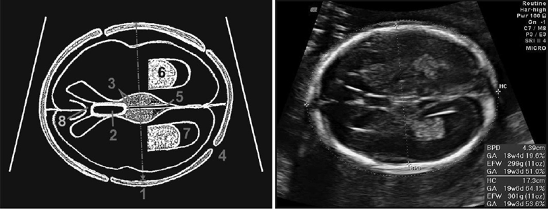 Fetal Lateral Ventricle Measurement Ultrasound 