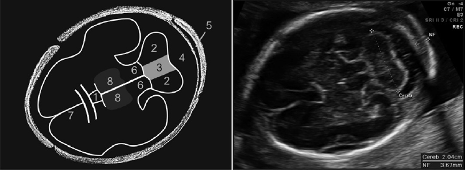 Fetal Brain Ultrasound Labeled