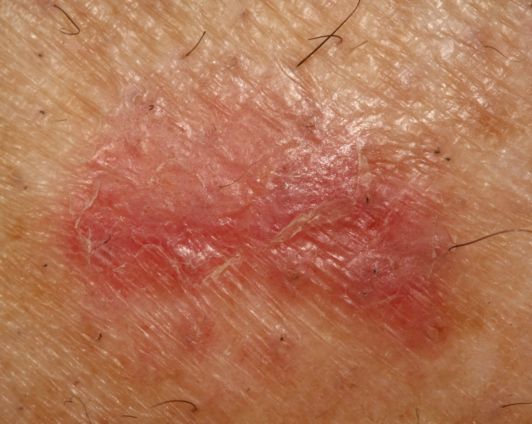 Basal Cell Carcinoma: Clinical Presentation and Management - The ObG ...